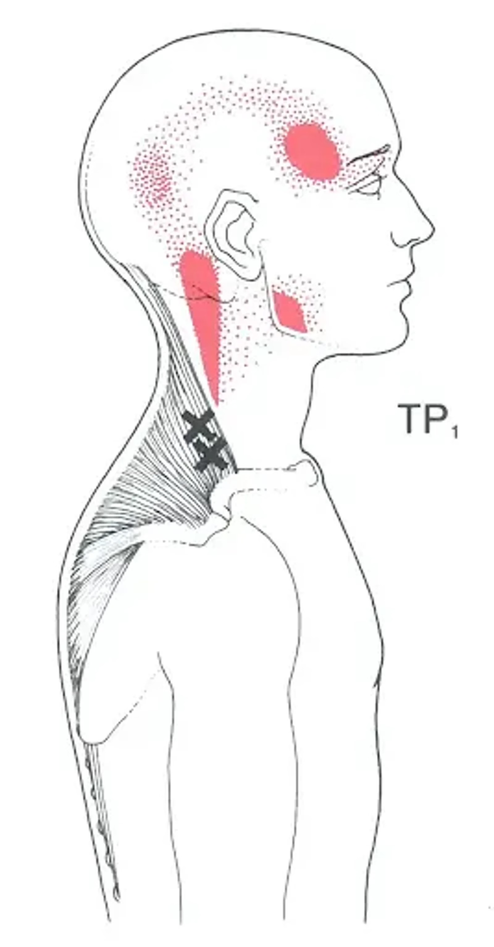 Point gâchette ou trigger points du trapèze
