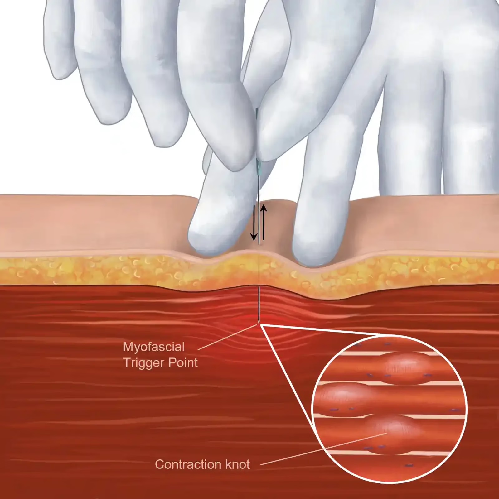 Technique du dry needling appliqué aux points gâchettes.