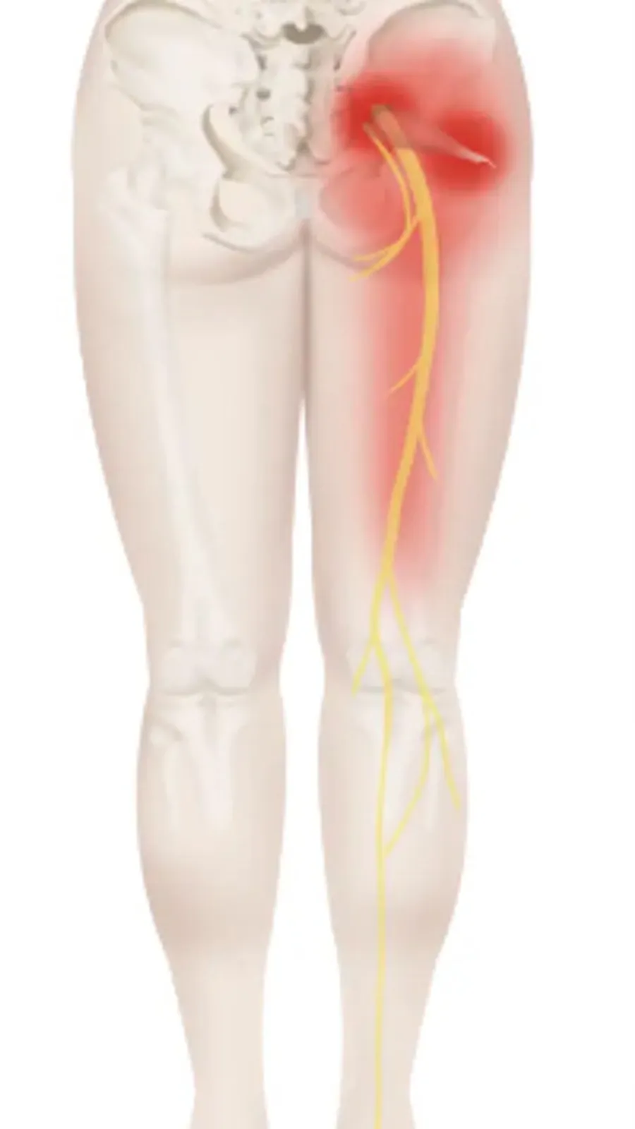 Typical location of referred pain in the buttock and thigh