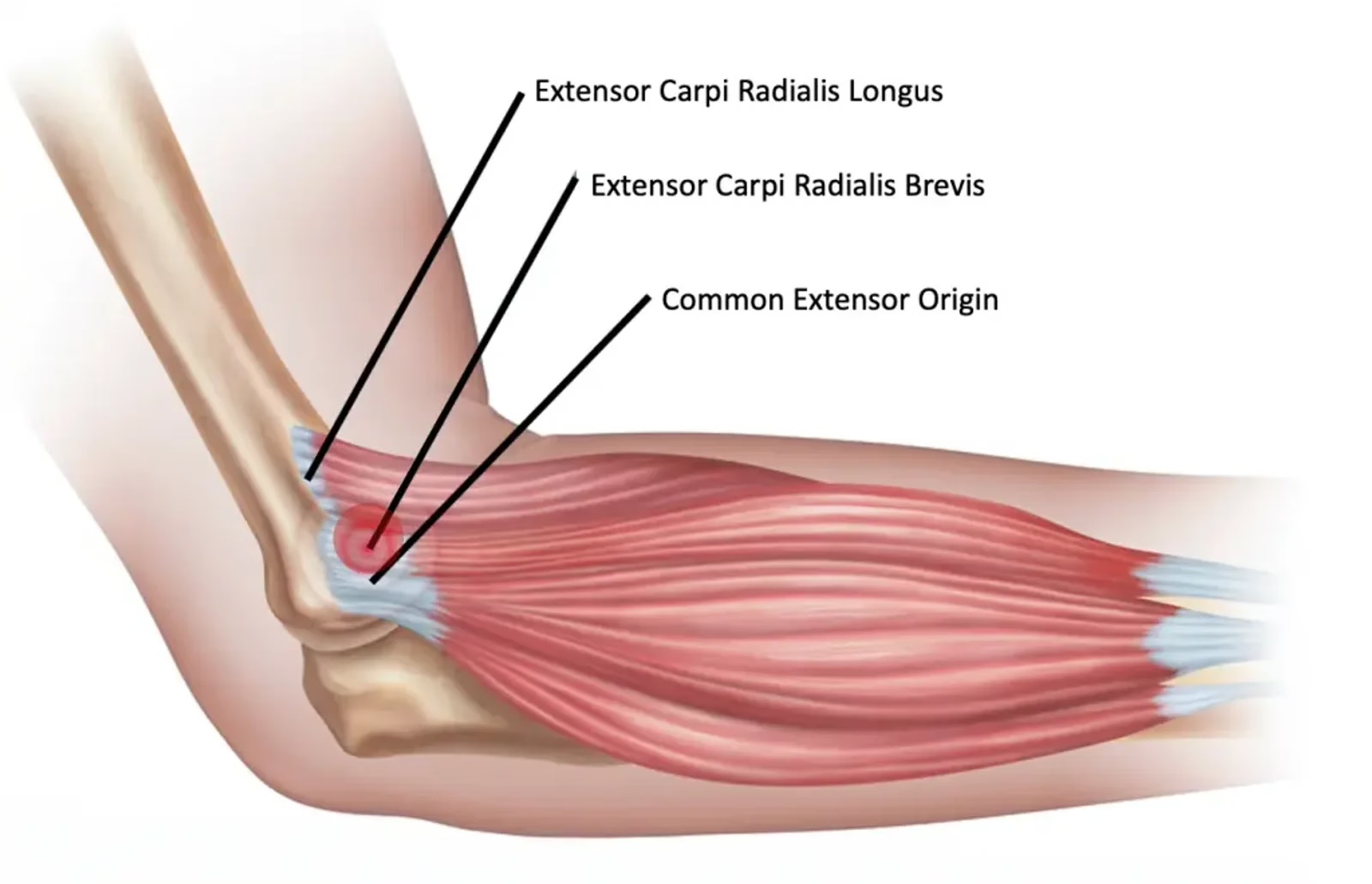 Tendons atteints lors d'une épicondylite latérale