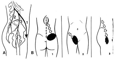 Traitement ostéopathique de la douleur pelvienne chronique, Beyrouth