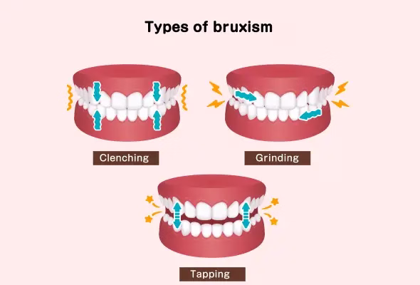 The different types of bruxism: sleep and awake