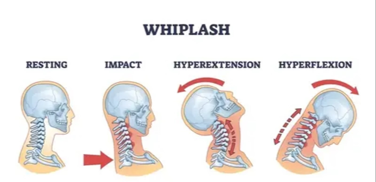 Schematic representation of whiplash, effects on the neck.