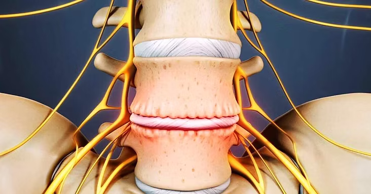 Degenerative lumbar spine L4-L5