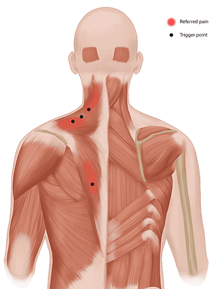 Myofascial pain syndrome, referred pain and trigger point