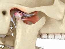 Anatomical diagram of the temporomandibular joint (TMJ)