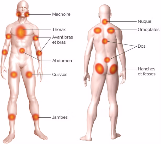 Zones articulaires et musculaires douloureuses dans la fibromyalgie